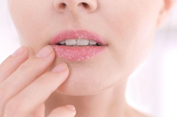 Tips Mudah Mengatasi Bibir Kering dan Pecah-Pecah  Secara Alami