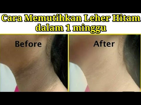 Hanya Dengan Dua Bahan! Begini Cara Mudah Menghilangkan Hitam di Leher