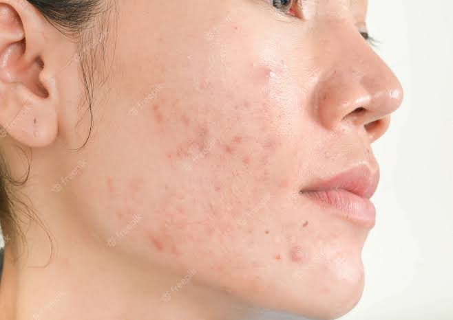 Rekomendasi Moisturizer Untuk Kulit Berjerawat. Pejuang Acne Wajib Baca!