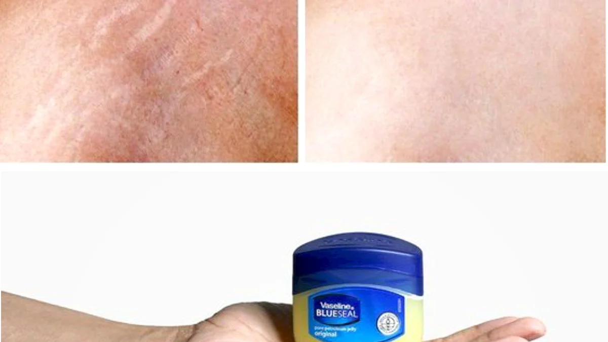 Ampuh dalam Satu Minggu? Cara Menghilangkan Stretch Mark Dengan Vaseline