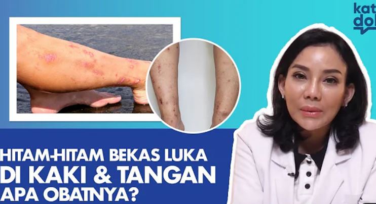 Koreng Mengganggu Penampilan? Begini cara Menghilangkannya