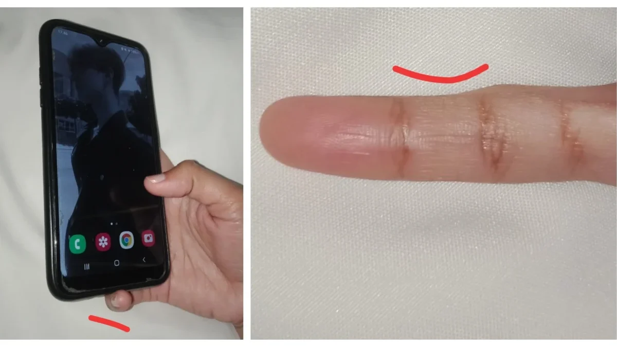 Jari Kelingking Kamu Bengkok Kayak Gini? Awas Kena Sindrom Smartphone Pinky!