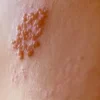 Gejala Penyakit Herpes pada Kulit Manusia