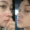 Acne Fighter Merapat! Ini 7 Skincare Korea untuk Jerawat yang Ampuh 2024