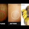 Stretch Mark Bikin Gak PD? Pakai Bahan Alami ini! Dijamin Stretch Mark Langsung Hilang!