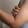 Keratosis Pilaris