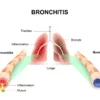 Bronkitis terbagi menjadi dua jenis: bronkitis akut dan bronkitis kronis