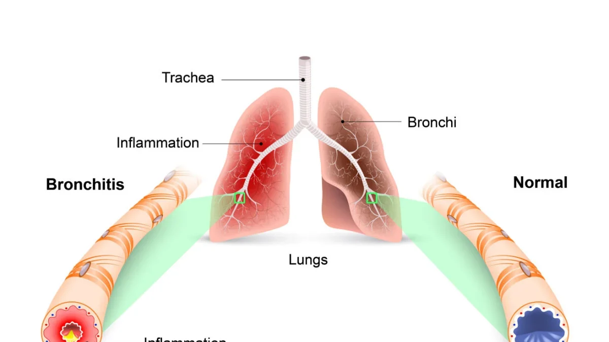 Bronkitis terbagi menjadi dua jenis: bronkitis akut dan bronkitis kronis