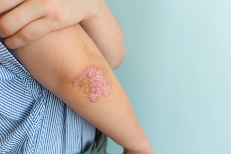 Gejala psoriasis yang bisa bervariasi, tergantung pada jenis yang dialami pasien