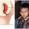 Mengenal Atresia Ani, Kelainan Langka yang Dialami Bocah Asal Sumedang