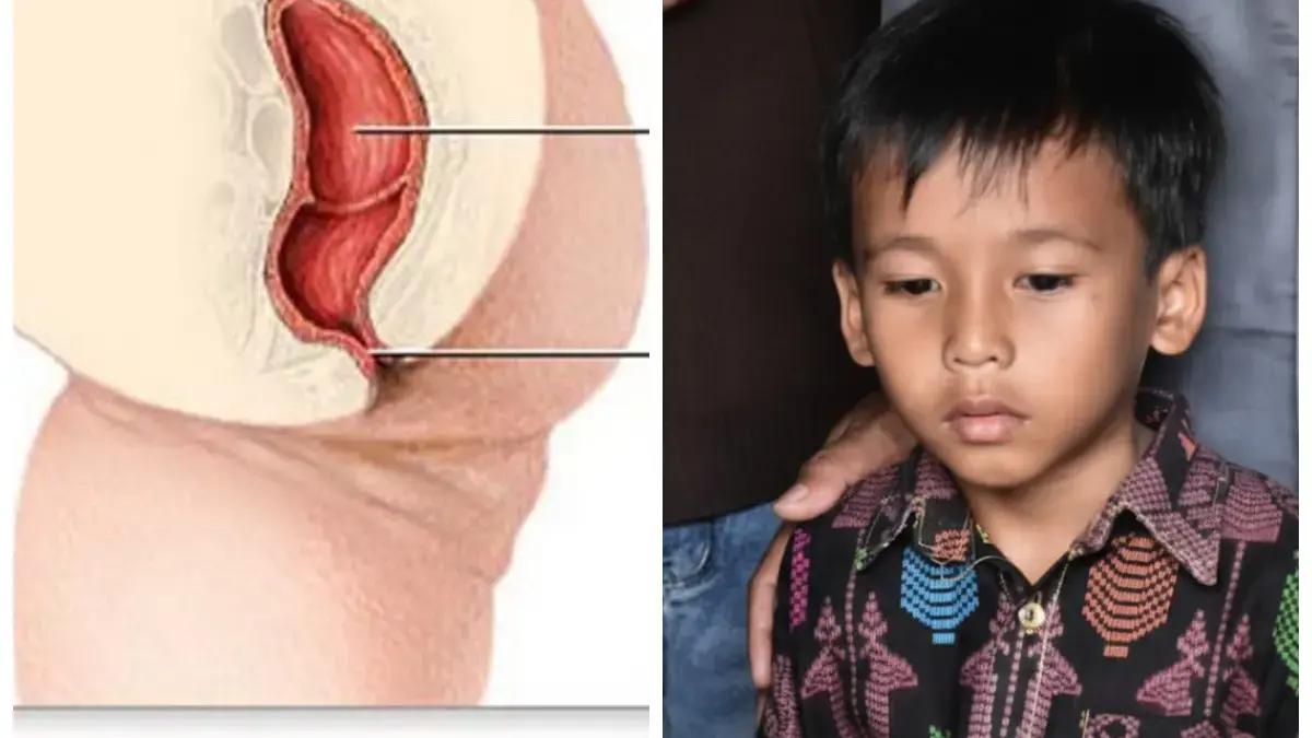 Mengenal Atresia Ani, Kelainan Langka yang Dialami Bocah Asal Sumedang
