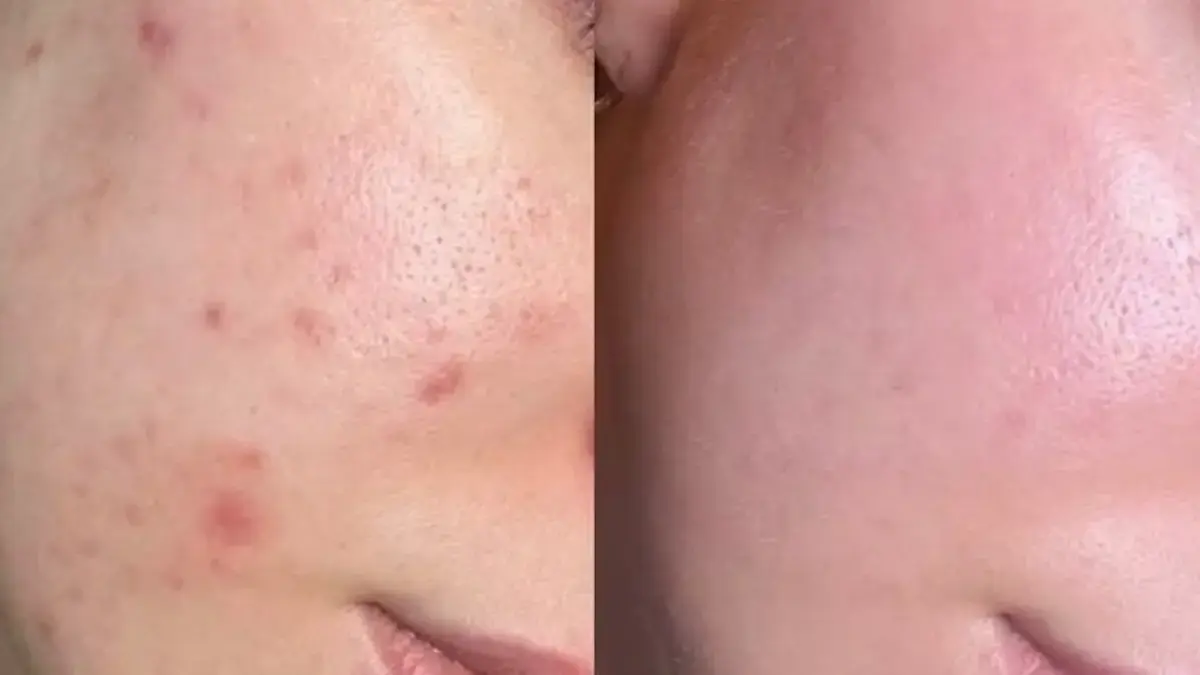 Skincare-Friendly untuk Kulit Sensitif Berjerawat: Hindari Alkohol & Pilih Tekstur Gel!