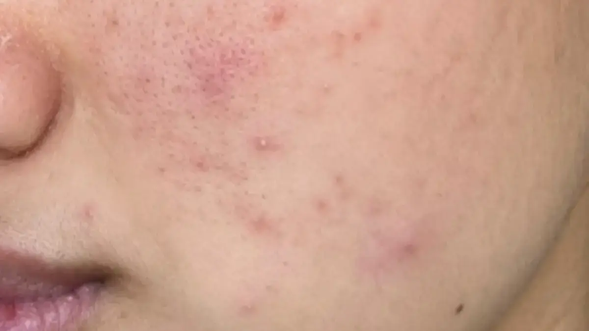 Bangun dengan Kulit Lebih Tenang: Cara Mengatasi Kemerahan & Breakout Saat Tidur