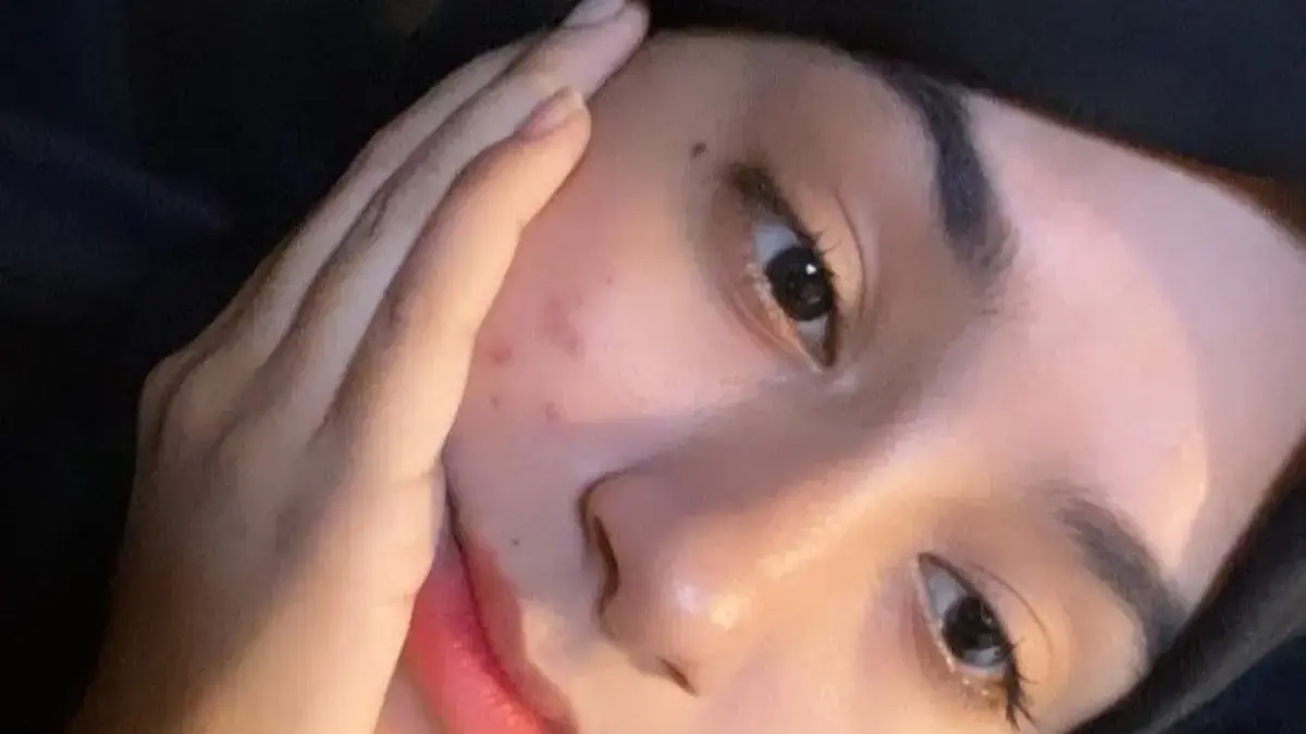 Kenapa Kulit Berjerawat Butuh Night Cream Khusus? Dermatology-Friendly & Wajib Kamu Tahu!