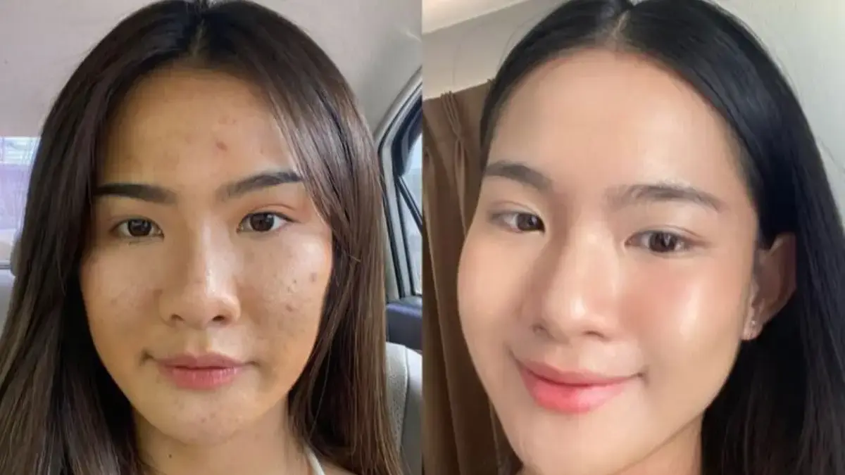 Cara Cepat Menyamarkan Bekas Jerawat Tanpa Ribet: Cukup Perbaiki Rutinitas Malammu! Cara Cepat Menyamarkan Bekas Jerawat Tanpa Ribet: Cukup Perbaiki Rutinitas Malammu!