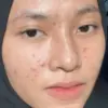 Perbedaan Acne Cream vs Night Cream Anti Acne: Mana yang Tepat untuk Kulitmu