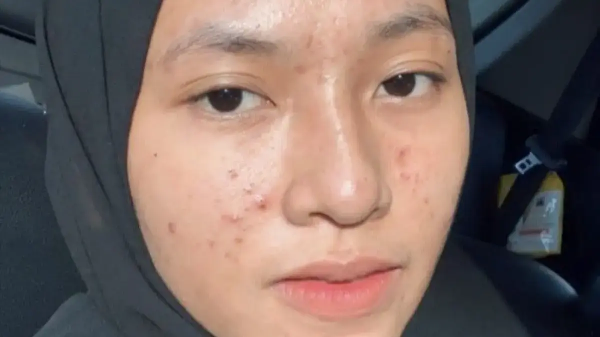 Perbedaan Acne Cream vs Night Cream Anti Acne: Mana yang Tepat untuk Kulitmu
