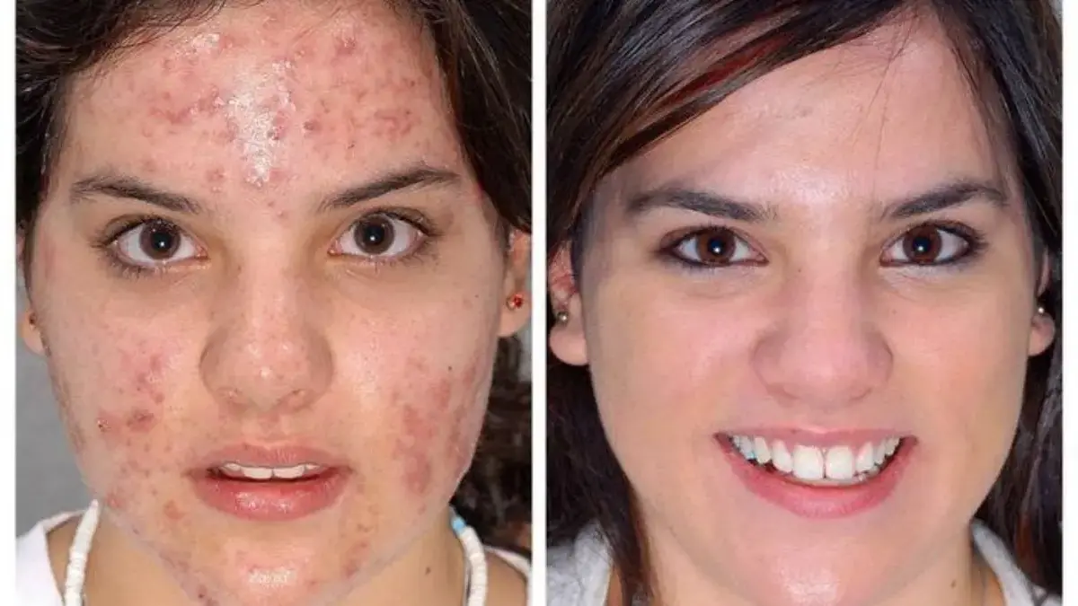 Pori Membesar & Mudah Berjerawat? Begini Cara Mengontrol Sebum