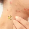 Jerawat Nongol Mendadak? Ini Cara Redamnya dalam Hitungan Jam