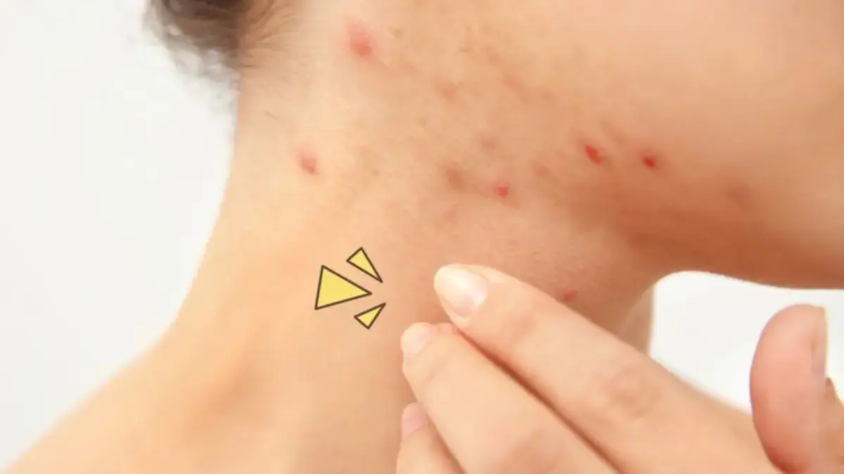 Jerawat Nongol Mendadak? Ini Cara Redamnya dalam Hitungan Jam Jerawat Nongol Mendadak? Ini Cara Redamnya dalam Hitungan Jam