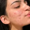 Salah Rawat Jerawat Bisa Bikin Makin Parah, Ini Kesalahan yang Harus Dihindari!
