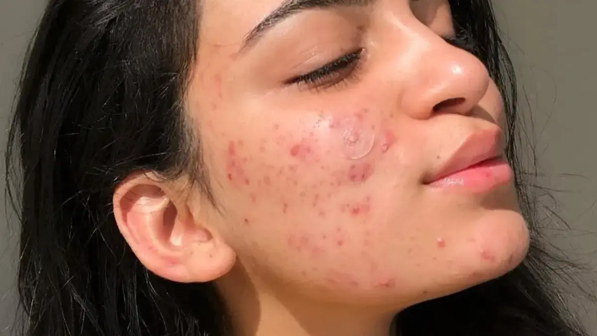 Salah Rawat Jerawat Bisa Bikin Makin Parah, Ini Kesalahan yang Harus Dihindari!