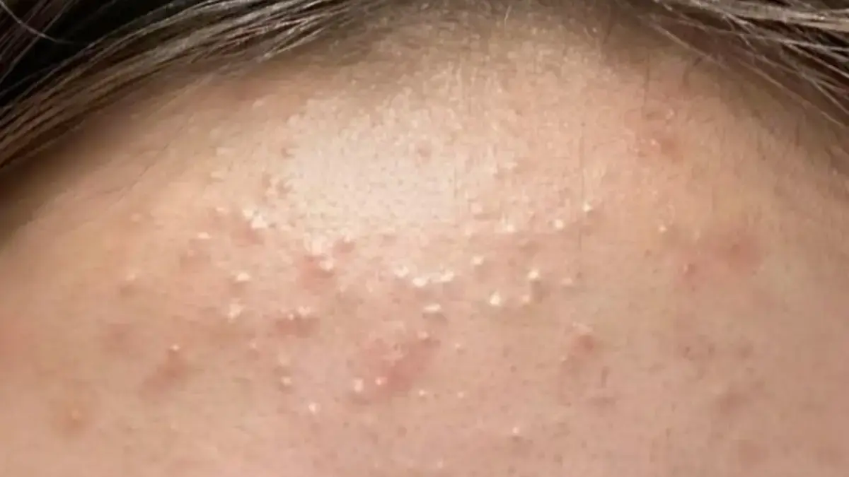 Jerawat Kecil-Kecil di Dahi & Rahang? Tanda Sebum Berlebih, Ini Cara Atasinya Jerawat Kecil-Kecil di Dahi & Rahang? Tanda Sebum Berlebih, Ini Cara Atasinya