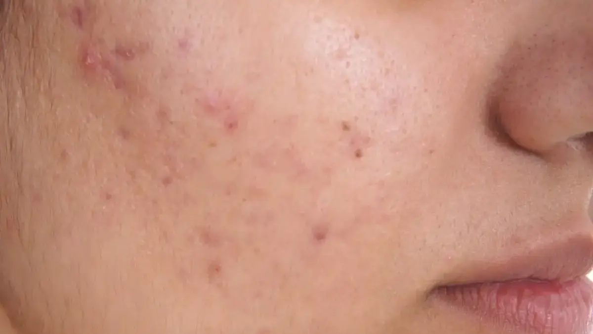 Purging atau Breakout? Kenali Perbedaannya Biar Tidak Salah Panik!