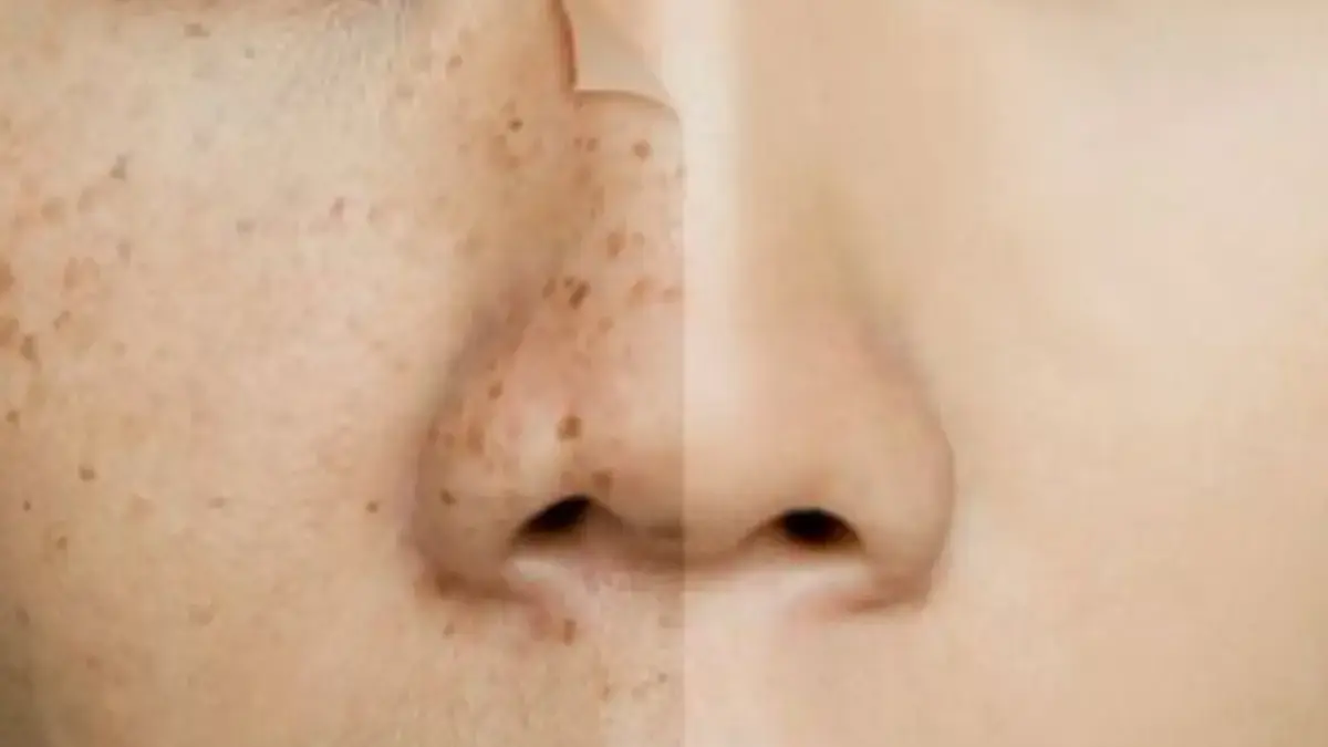 Super Gampang, Inilah 7 Tips Untuk Hilangkan Noda Hitam Membandel di Wajah