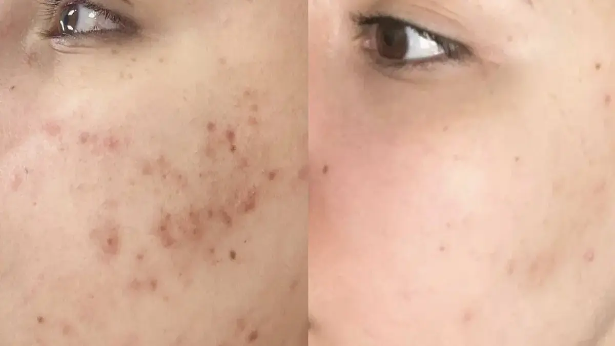 Cara Mengeringkan Jerawat Tanpa Bikin Kulit Jadi Kering & Mengelupas Cara Mengeringkan Jerawat Tanpa Bikin Kulit Jadi Kering & Mengelupas