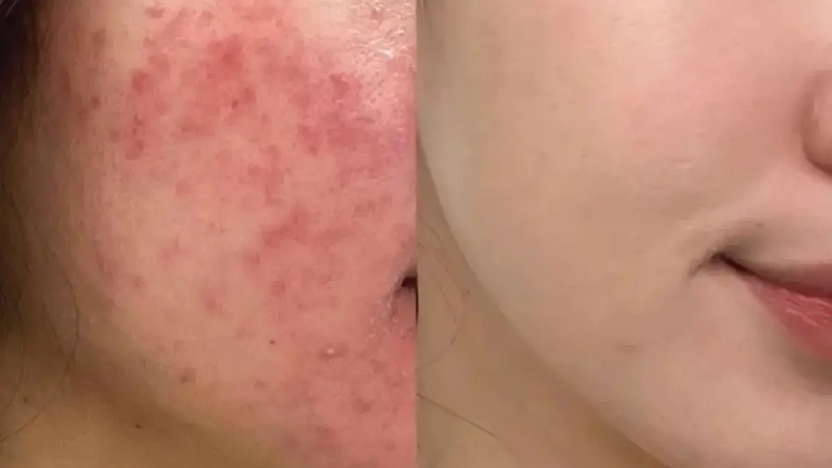 Jerawat Meradang & Sakit Saat Disentuh? Ini Cara Menenangkannya