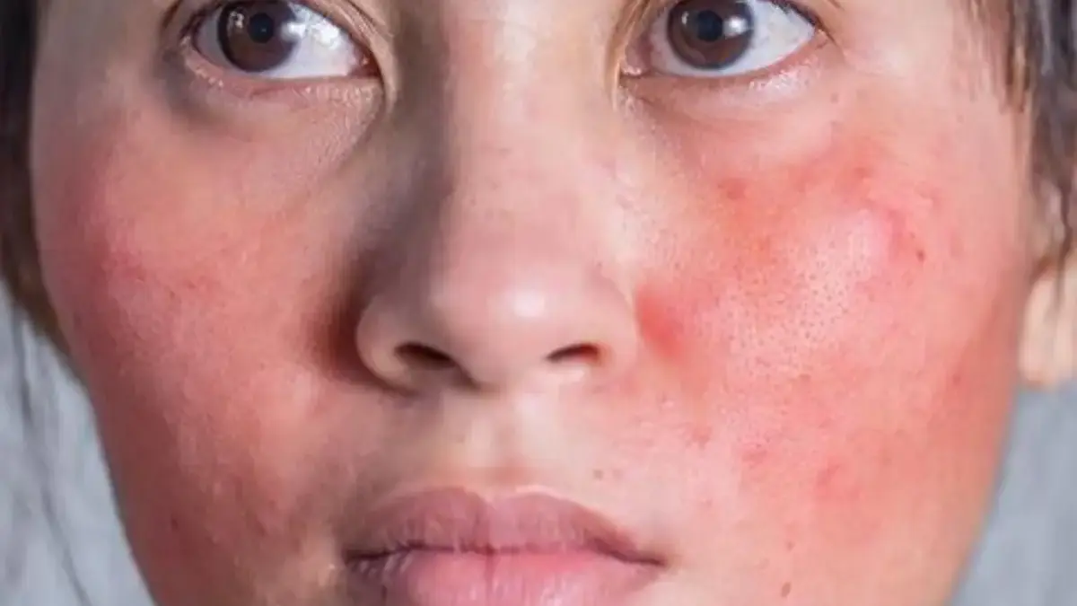 Kulit Sensitif & Mudah Merah? Ini Kandungan yang Bisa Menenangkannya Kulit Sensitif & Mudah Merah? Ini Kandungan yang Bisa Menenangkannya