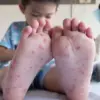Dinkes Sumedang Waspadai Flu Singapura, Ini Gejala dan Cara Pencegahannya