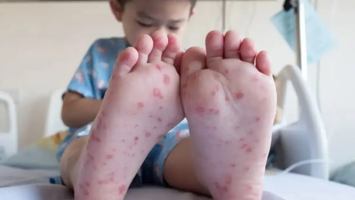Dinkes Sumedang Waspadai Flu Singapura, Ini Gejala dan Cara Pencegahannya Dinkes Sumedang Waspadai Flu Singapura, Ini Gejala dan Cara Pencegahannya